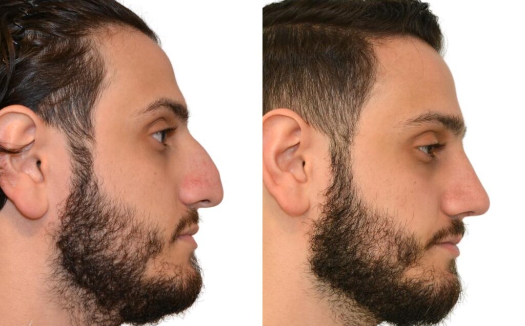 Rhinoplasty
