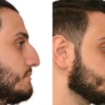 Rhinoplasty