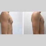 Is Gynecomastia Surgery the Right Choice for Men in Dubai?