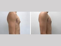 Is Gynecomastia Surgery the Right Choice for Men in Dubai?