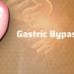 gastric bypass surgery