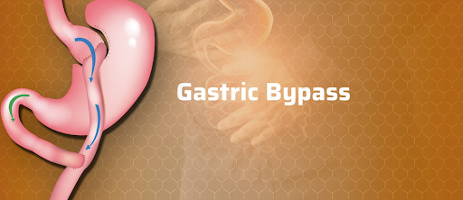 gastric bypass surgery